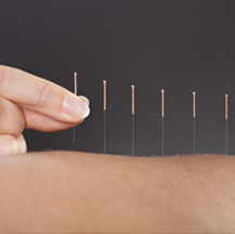 Acupuncture